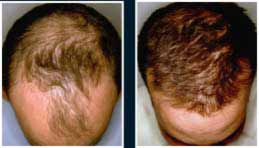 Per l'alopecia - FOLLIXIN